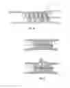Fig. 10 - Embolisation systems