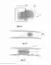 Fig. 13 - Embolisation systems