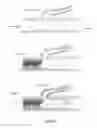 Fig. 23 - Embolisation systems