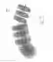 Fig. 53 - Embolisation systems