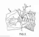 Fig. 03 - Devices and methods for preparing an intervertebral workspace