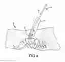 Fig. 04 - Devices and methods for preparing an intervertebral workspace