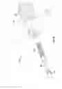 Fig. 13 - Methods and apparatus for treating vertebral fractures