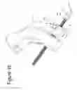 Fig. 11 - INSTRUMENT FOR FRACTURE FRAGMENT ALIGNMENT AND STABILIZATION