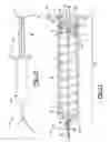 Fig. 06 - Surgical tool for removing kidney stone