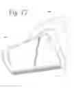 Fig. 15 - Hand held dermaplaning device and dermaplaning process