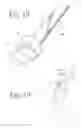 Fig. 16 - Hand held dermaplaning device and dermaplaning process