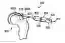 Fig. 01 - Dilator for accessing a joint space