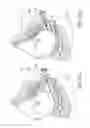 Fig. 16 - METHODS AND APPARATUS FOR PREVENTING VAGINAL LACERATIONS DURING CHILDBIRTH