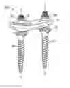 Fig. 01 - Posterior Lumbar Plate