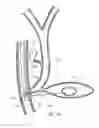Fig. 05 - EUS fiducial needle stylet handle assembly
