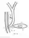 Fig. 06 - EUS fiducial needle stylet handle assembly