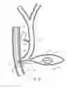 Fig. 07 - EUS fiducial needle stylet handle assembly