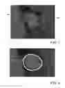 Fig. 05 - Evaluating prosthetic heart valve placement