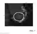 Fig. 06 - Evaluating prosthetic heart valve placement