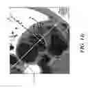 Fig. 17 - Evaluating prosthetic heart valve placement