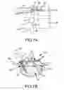 Fig. 09 - Image-guided minimal-step placement of screw into bone