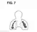 Fig. 08 - Metal Bite Strip