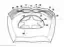 Fig. 01 - IMPLANTABLE PROSTHESIS