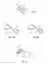 Fig. 08 - ENDOLUMINAL FILTER DESIGN VARIATIONS