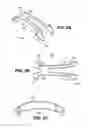 Fig. 04 - Scleral prosthesis for treating presbyopia and other eye disorders and related devices and methods