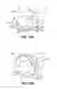Fig. 15 - Scleral prosthesis for treating presbyopia and other eye disorders and related devices and methods