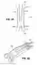 Fig. 03 - Scleral prosthesis for treating presbyopia and other eye disorders and related devices and methods