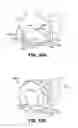 Fig. 15 - Scleral prosthesis for treating presbyopia and other eye disorders and related devices and methods