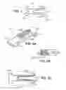Fig. 06 - Scleral prosthesis for treating presbyopia and other eye disorders and related devices and methods