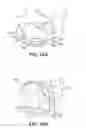 Fig. 15 - Scleral prosthesis for treating presbyopia and other eye disorders and related devices and methods