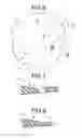 Fig. 04 - Intraocular lens