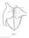Fig. 02 - Devices and methods for retrievable intra-atrial implants