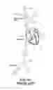 Fig. 48 - Devices and methods for retrievable intra-atrial implants