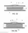 Fig. 52 - Devices and methods for retrievable intra-atrial implants