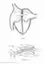 Fig. 55 - Devices and methods for retrievable intra-atrial implants