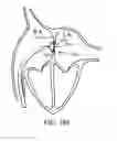 Fig. 65 - Devices and methods for retrievable intra-atrial implants