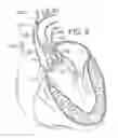 Fig. 05 - System and method for treating valve insufficiency or vessel dilatation