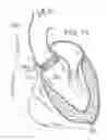 Fig. 10 - System and method for treating valve insufficiency or vessel dilatation