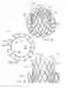 Fig. 11 - System and method for treating valve insufficiency or vessel dilatation