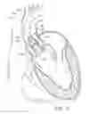 Fig. 12 - System and method for treating valve insufficiency or vessel dilatation