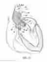 Fig. 16 - System and method for treating valve insufficiency or vessel dilatation
