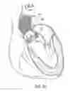 Fig. 18 - System and method for treating valve insufficiency or vessel dilatation