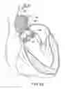 Fig. 19 - System and method for treating valve insufficiency or vessel dilatation