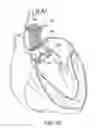 Fig. 20 - System and method for treating valve insufficiency or vessel dilatation