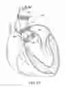 Fig. 22 - System and method for treating valve insufficiency or vessel dilatation