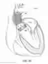 Fig. 23 - System and method for treating valve insufficiency or vessel dilatation