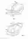 Fig. 02 - Transforaminal prosthetic spinal disc apparatus