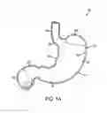 Fig. 02 - Gastric restriction devices for treating obesity
