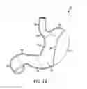 Fig. 03 - Gastric restriction devices for treating obesity
