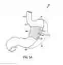 Fig. 08 - Gastric restriction devices for treating obesity